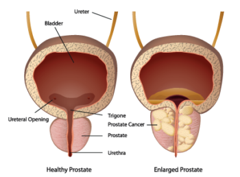 How do you get rid of prostate cancer